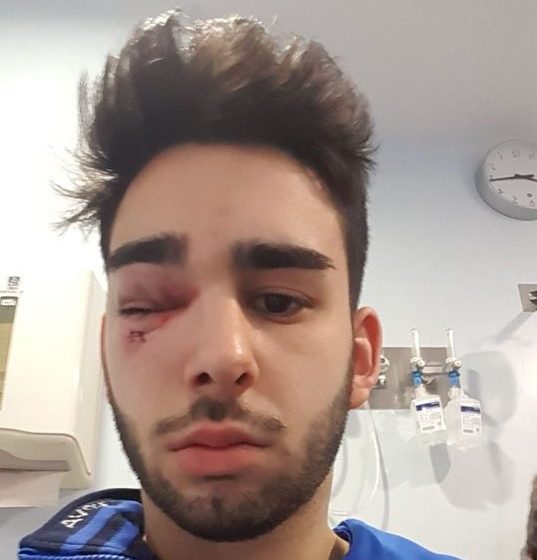 frederico Neves olho Frederico Neves lesionado com gravidade